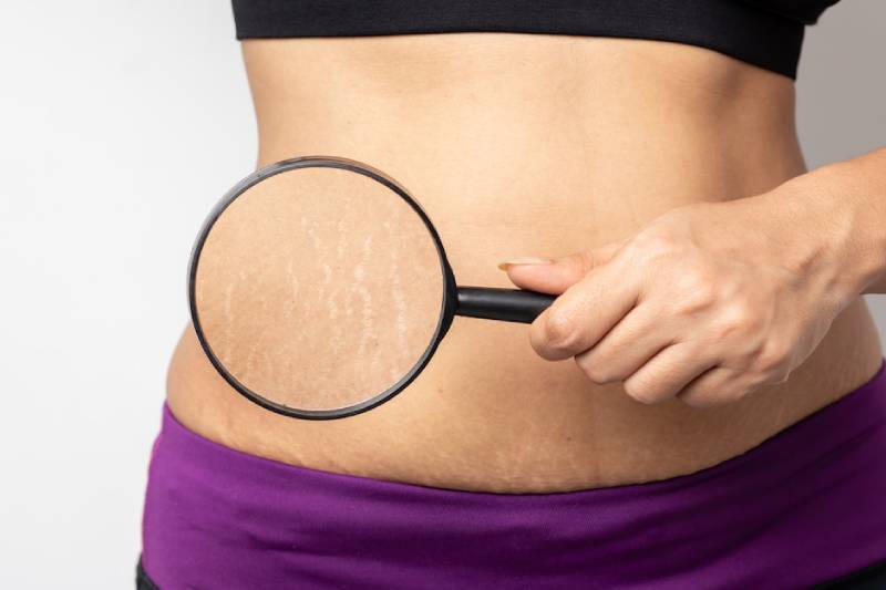 Home Remedies for Stretch Marks: Say Goodbye to Skin Stripes