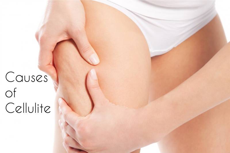 Causes of Cellulite: Prevention and Treatment Options