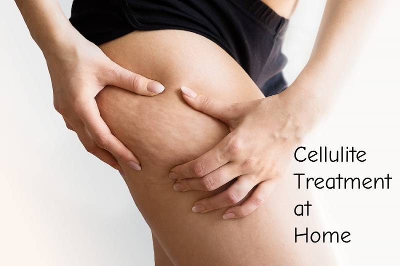 model showing cellulite issue so that we can treat at home