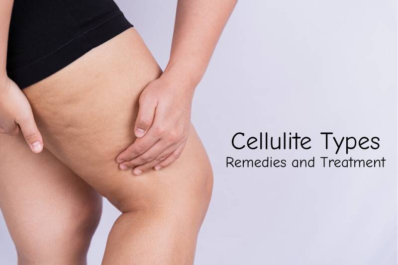 Best Cellulite Reduction Treatment in Delhi