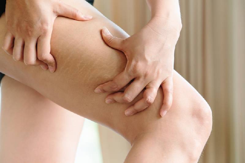 Cellulite Types: Home Remedies And Treatments