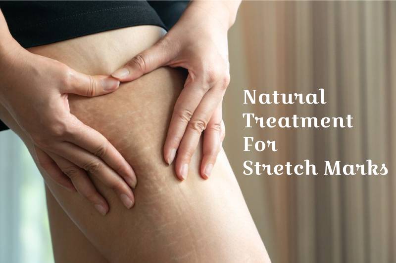 Natural Treatments for Stretch Marks: Benefits and Diet plan