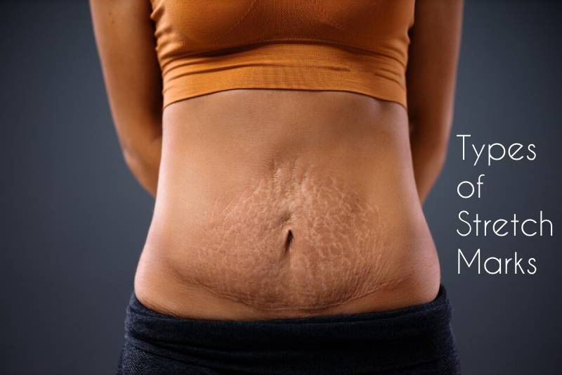 Types of Stretch Marks: Causes, Prevention, & Treatment